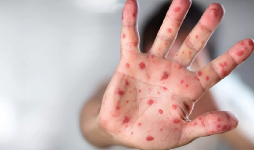  На Тамбовскую область ступает корь