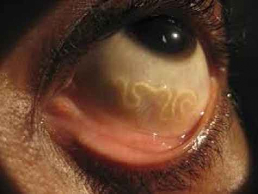 Тамбовские офтальмологи извлекли из глаза пациентки 10-сантиметрового червя